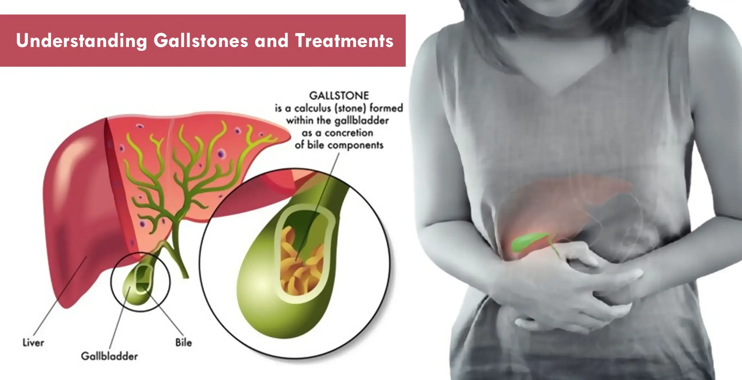 Gallbladder Stone Surgery Cost in Noida - Types, Factors & FAQs | Kasha Health